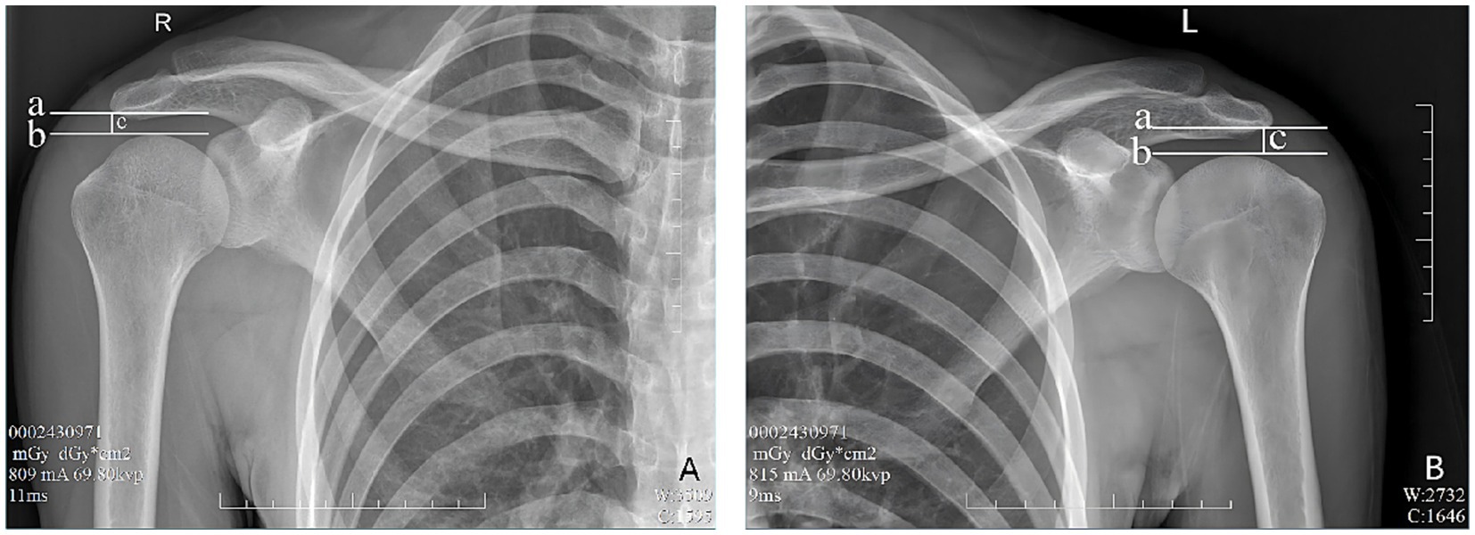 X-ray images of right and left shoulders with labels