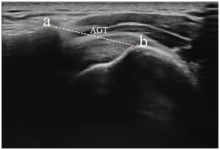Ultrasound image showing two points labeled