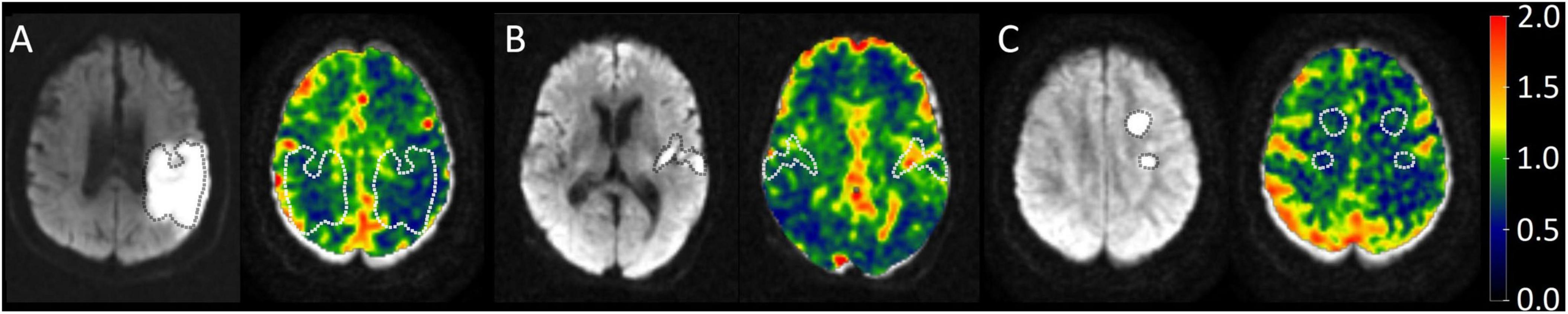 MRI images showing brain scans in three panels labeled A, B, and C. Each panel contains two brain scans: one in grayscale and the other in color. The colored scans use a scale from 0.0 (purple) to 2.0 (red) to indicate different activity levels. White and dotted outlines highlight specific brain regions in each panel, with distinct intensities and patterns visible.