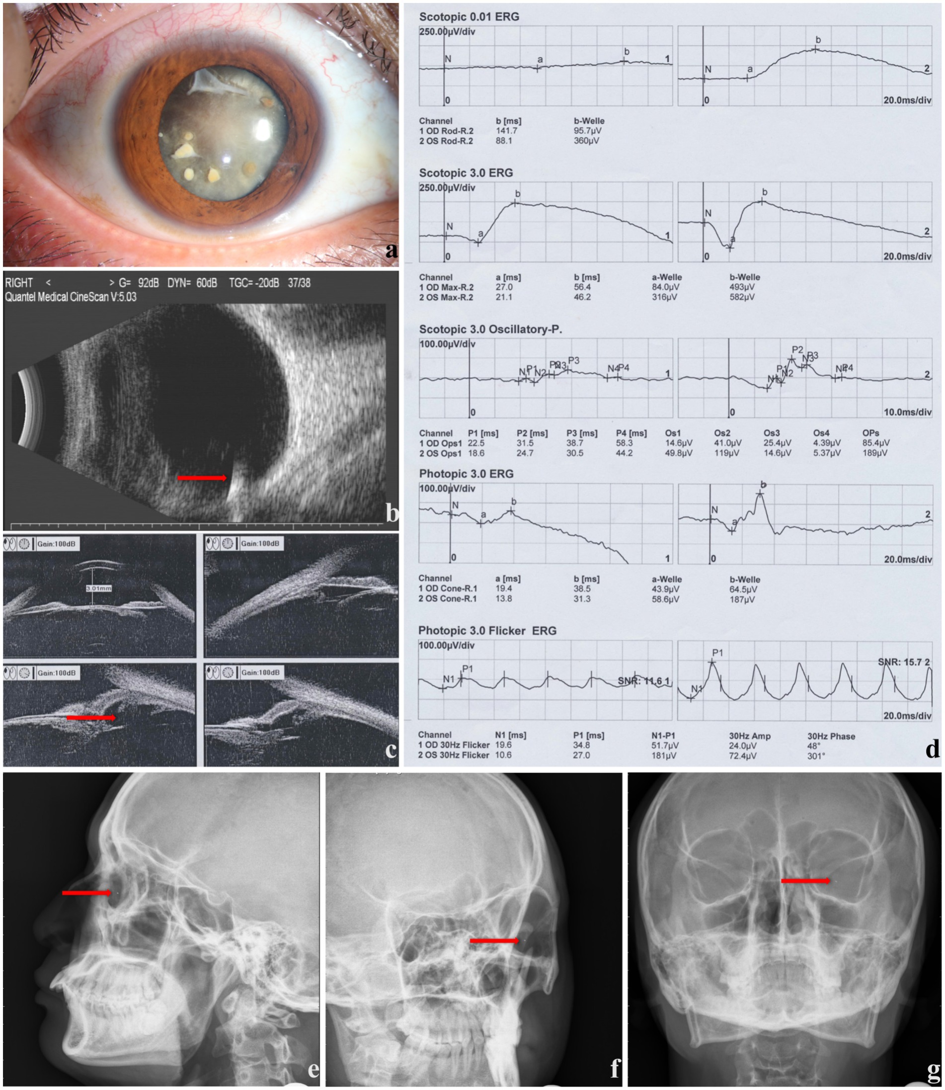 Multiple clinical images include: (a) a close-up of an eye with visible IOFB. (b-c) Ultrasound images of an eye affected by IOFB with red lines indicating specific areas. Electroretinography (ERG) graphs depicting eye function tests (d), and three X-ray images of a skull with red lines indicating specific areas (e, f, g). Each image provides diagnostic information about eye and skull conditions.
