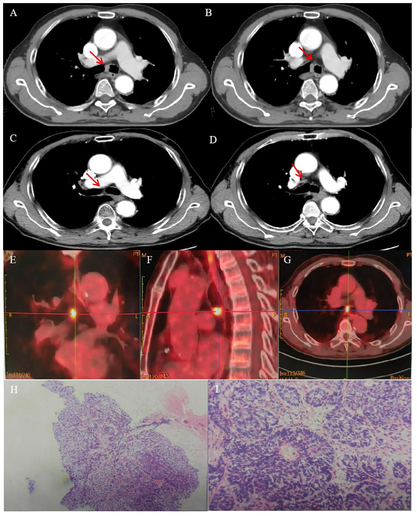 CT scans in panels A to D show a mass in the chest area indicated by red arrows. Panels E to G display PET scans with crosshairs highlighting areas of increased uptake. Panels H and I present histological images showing tissue samples with cellular structures stained in different shades.