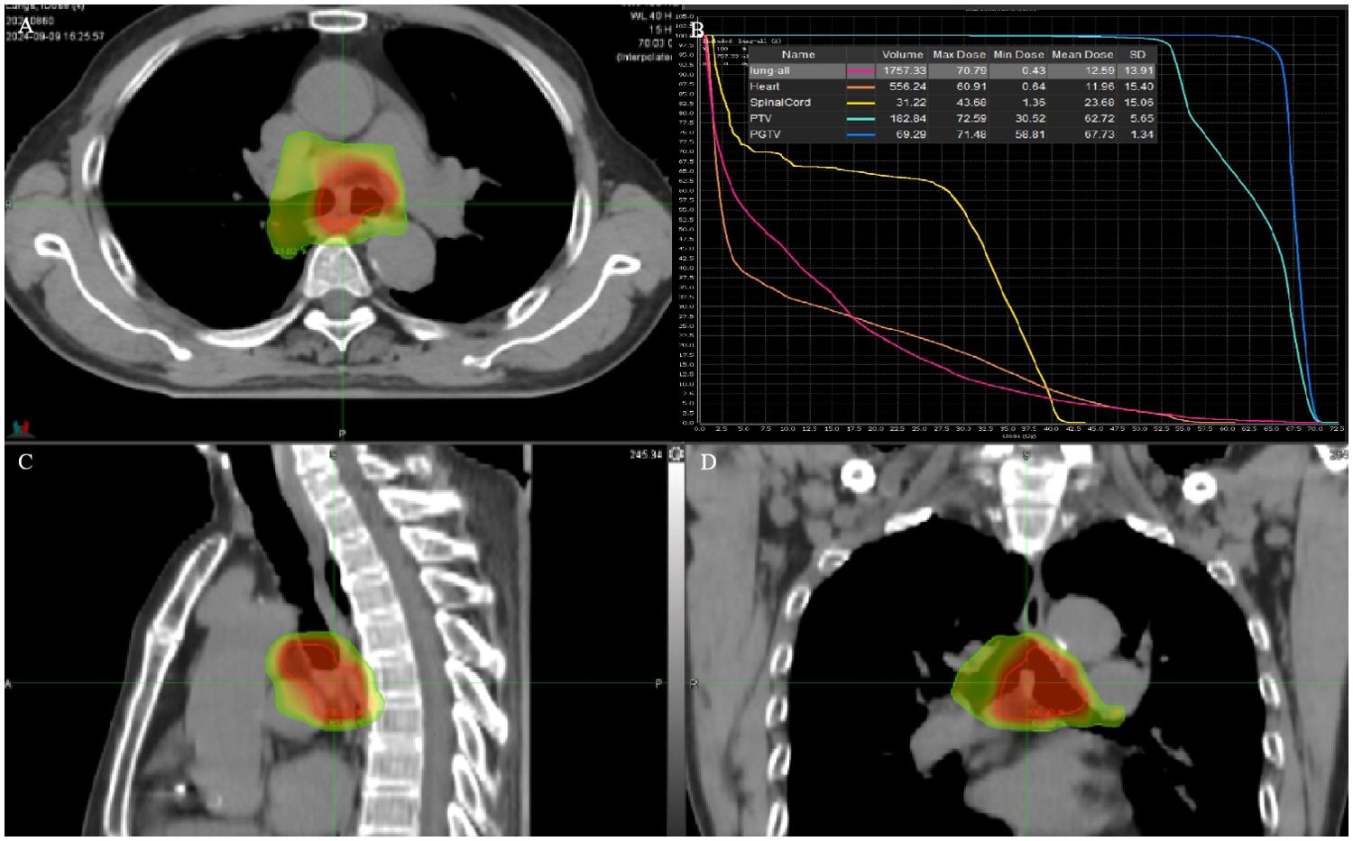 Composite image showing medical imaging and a dose-volume histogram. Panel A displays an axial CT scan with a highlighted region in the chest. Panel B shows a graph with curves representing dose distribution for different organs. Panel C presents a sagittal CT view with highlighted areas, and Panel D shows a coronal CT section with focused regions. Each panel highlights areas with color overlays indicating radiation targets and surrounding structures.