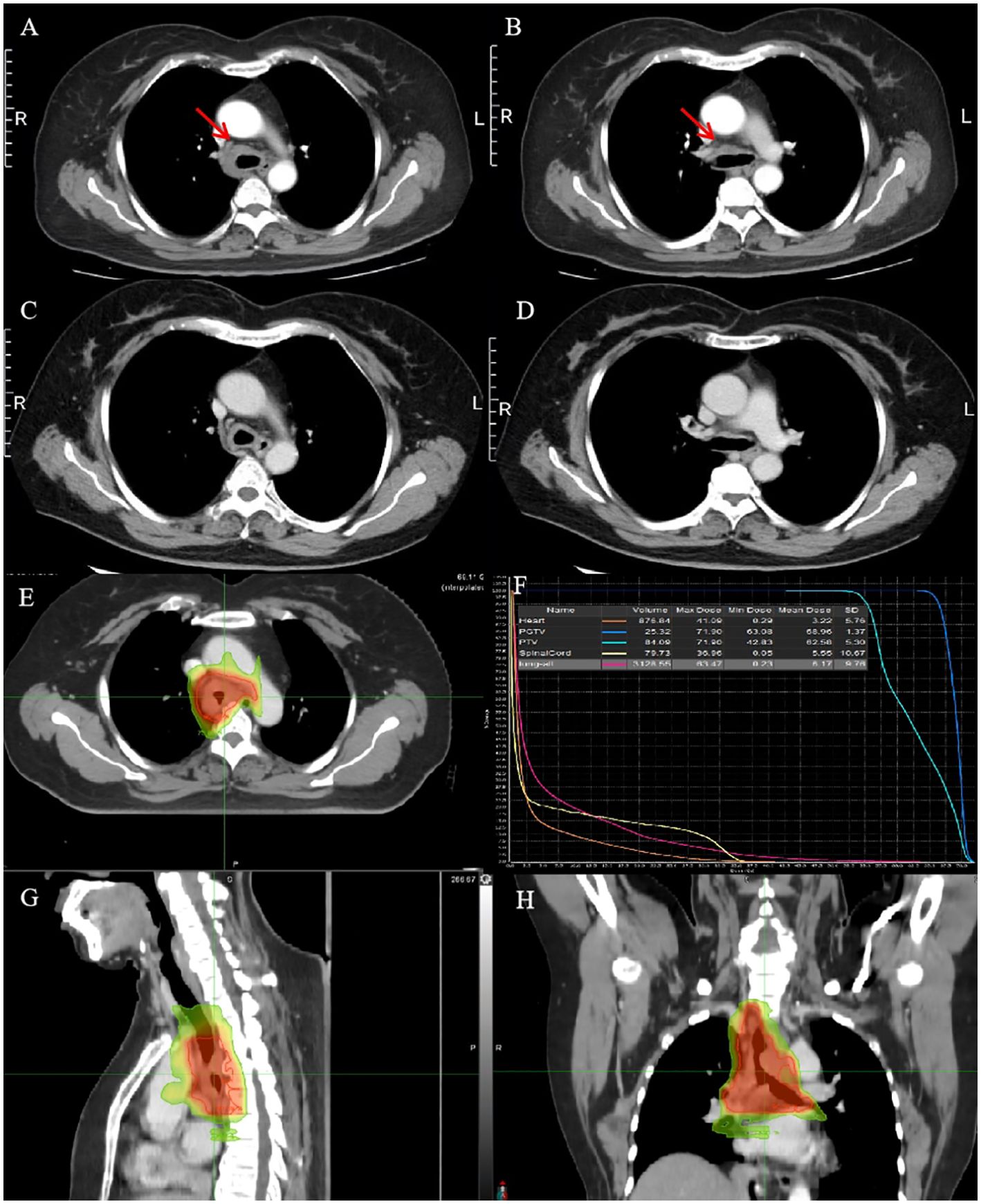 CT scans show the thoracic region, with panels A and B marked by red arrows indicating an area of interest. Panels C and D are additional CT slices without markers. Panel E highlights a colored region with crosshairs, while panel F presents a dose-volume histogram showing varying dose levels for different anatomical structures. Panels G and H display sagittal and coronal views of the thorax with highlighted areas.