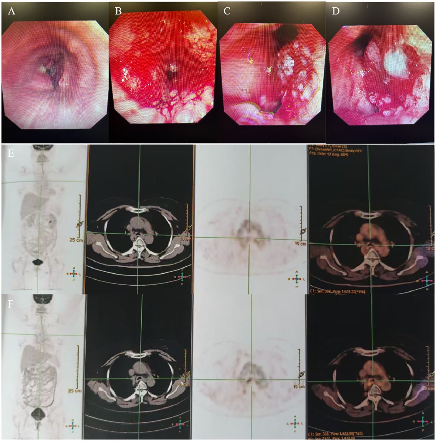 Endoscopic and PET scan images in a collage. Top row (A-D): Four endoscopic images showing variations in tissue appearance and color, with progression from normal to abnormal tissue. Bottom row (E-F): PET scan images in vertical pairs, displaying changes in metabolic activity across various body sections, highlighted by different contrast levels.