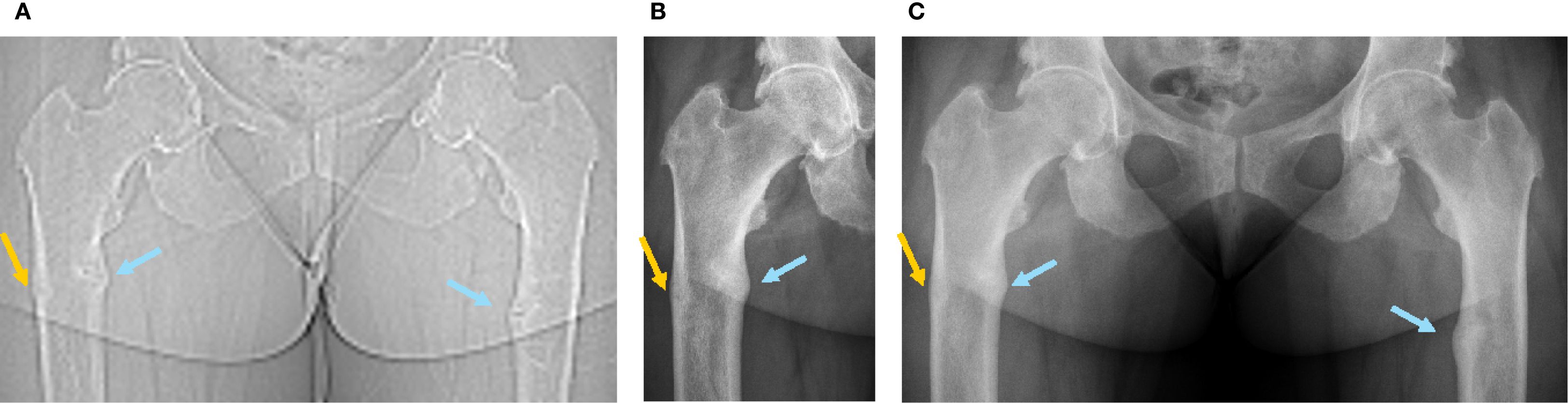 Three-panel image showing X-ray scans of a hip. Panel A shows a CT scan topogram with two blue arrows indicating fractures of the inner cortical femur diaphysis bilaterally, and one yellow arrow indicating a fracture of the outer cortical of the right femur. Panels B and C have standard X-rays, with blue and yellow arrows indicating the same region, in which only cortical thickening but no fracture trait is visible.