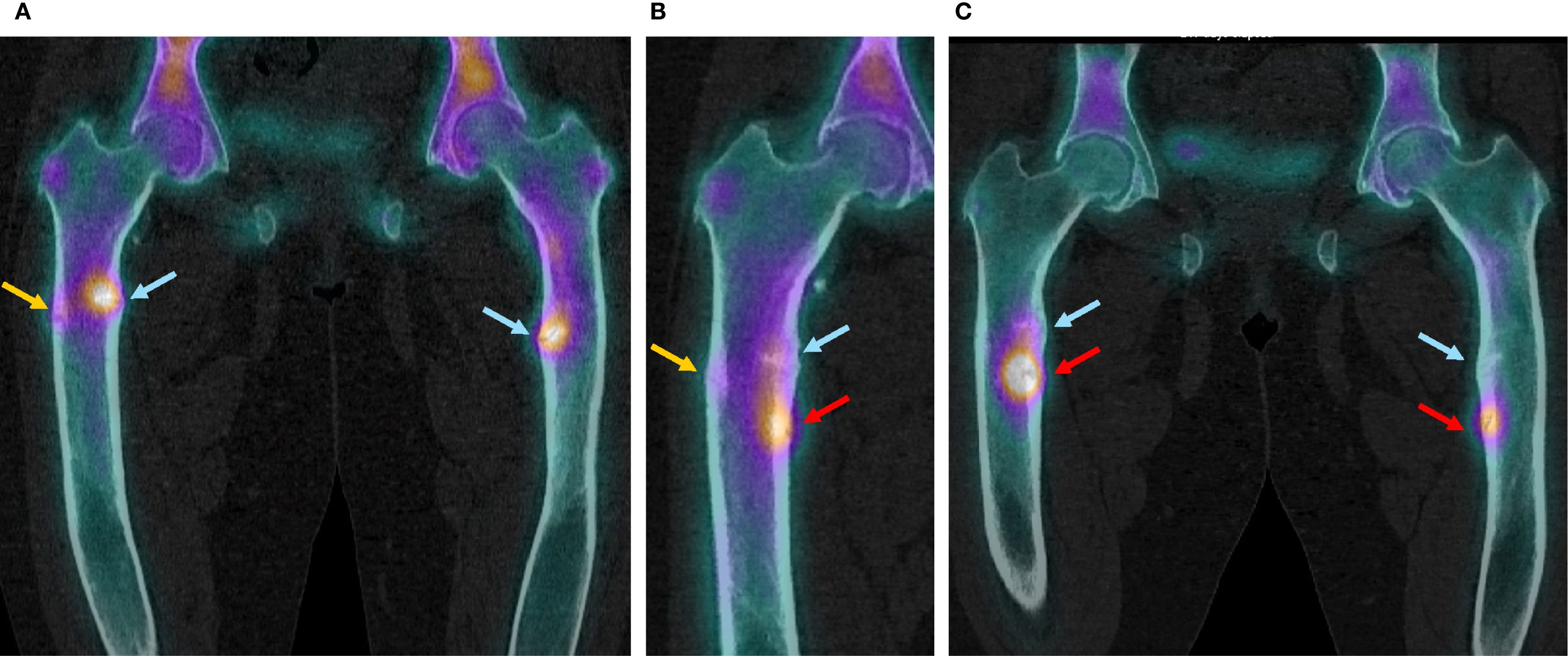 Composite SPECT-CT scans of femurs labeled A, B, and C. Each scan shows femur bones with areas capturing the radiotracer around cortical fractures indicated by arrows. Panel A has two blue arrows indicating the inner cortical femur diaphysis bilaterally, and one yellow arrow indicating the outer cortical of the left femur, all capturing the radiotracer. Panel B shows only the right femur with the blue and yellow arrows but less radiotracer capture, and a new red arrow distally in the inner cortical indicating a new fracture strongly capturing the radiotracer. Panel C shows both femurs with the two blue arrows as in panel A, with almost no capture of radiotracer, and two distal red arrows indicating new fractures of the inner cortical strongly capturing the radiotracer.