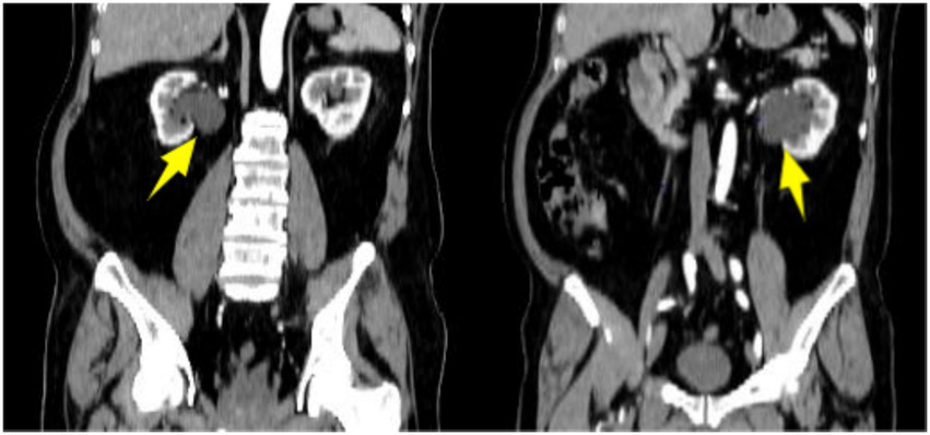 CT scan showing two sections of the abdomen with yellow arrows indicating specific areas of interest in each image. The scan highlights the structures of the kidney.