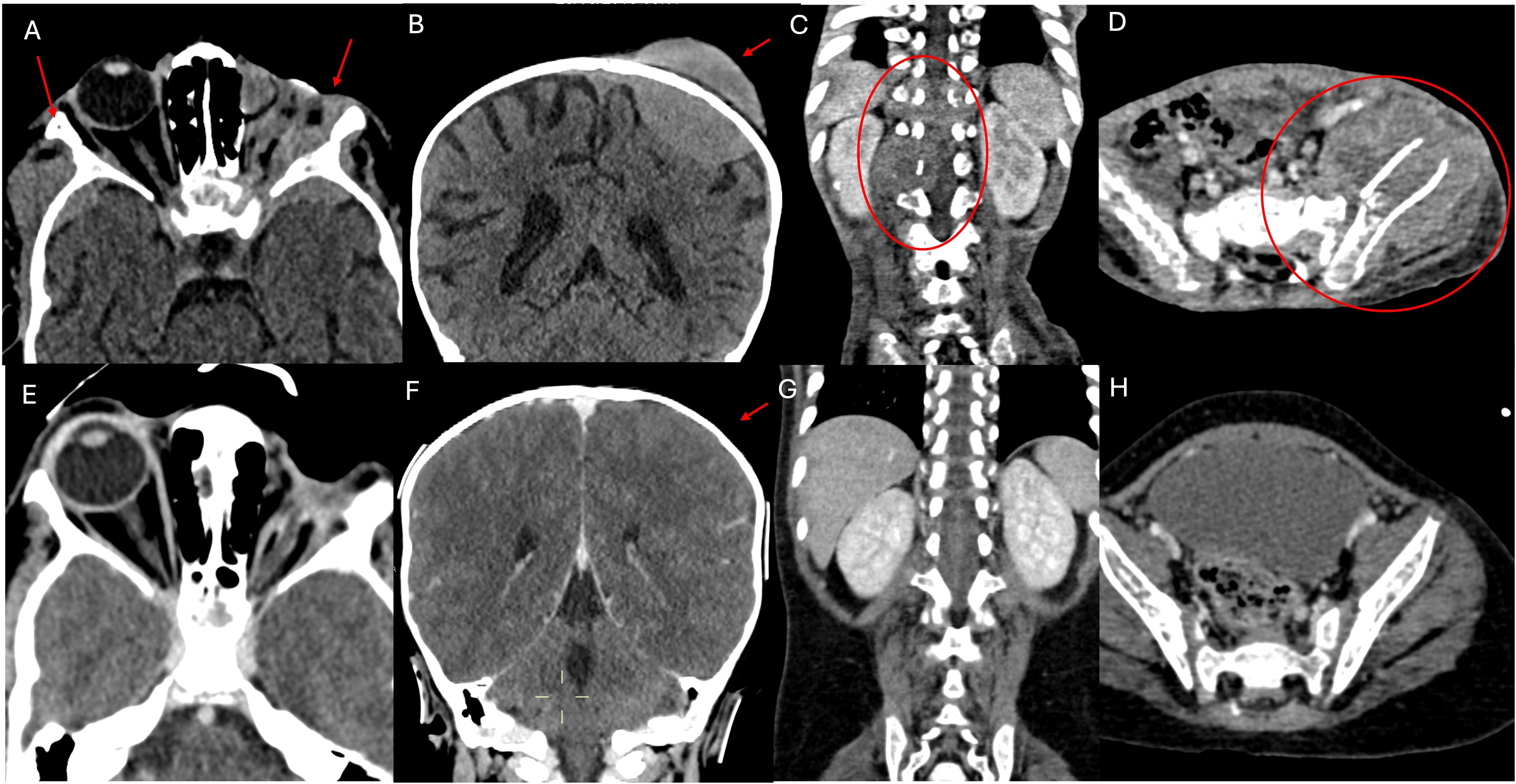 A series of CT scan images display various anatomical views and abnormalities marked by red arrows and circles. Panel A shows the head with two arrows indicating specific areas. Panel B highlights a cranial mass. Panel C presents a midsection view with a red circle around certain vertebrae. Panel D shows the pelvis with a marked region on the right side. Panel E features an unmarked head scan. Panel F shows the skull, marked with an arrow. Panel G is a coronal abdominal view revealing a mass on the left side. Panel H displays an unmarked pelvic scan.