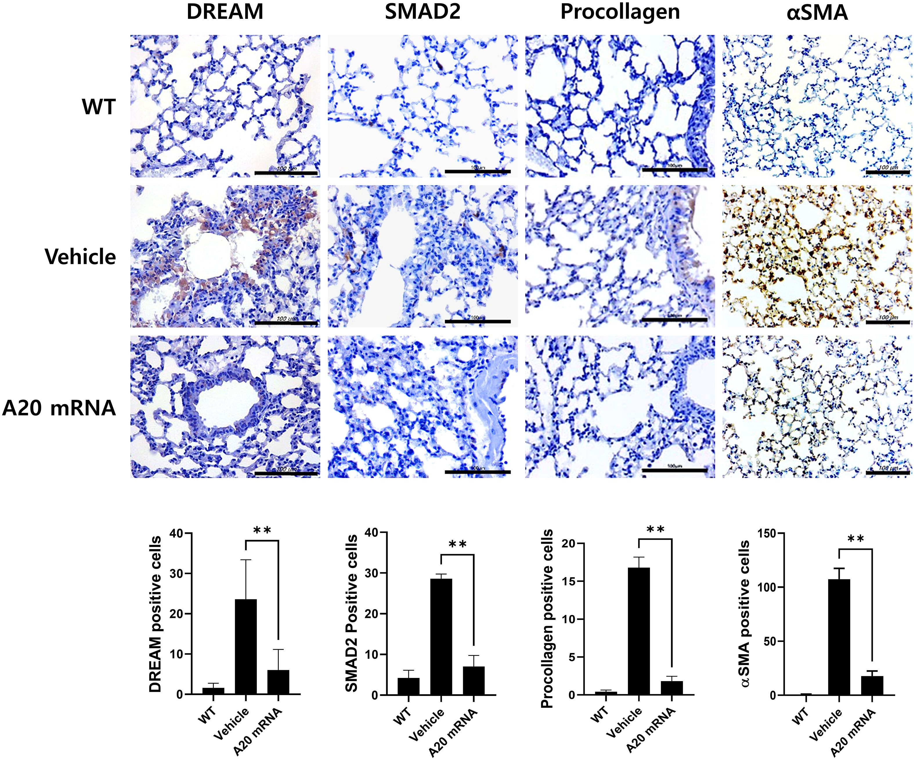 Histological images and bar graphs comparing DREAM, SMAD2, Procollagen, and αSMA expression in lung tissues. Rows represent WT, Vehicle, and A20 mRNA groups. Bar graphs below indicate significant differences in positive cell counts across the groups, denoted by asterisks. Scale bars are visible in images.
