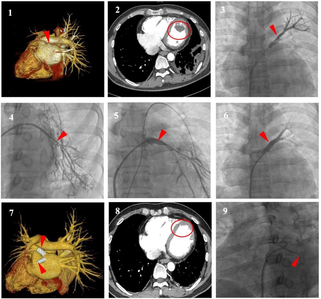 There are nine medical images highlighting heart and vascular structures. Panels 1 and 7 show 3D heart reconstructions with red arrows indicating specific areas. Panels 2 and 8 are CT scans with circles marking lesions or anomalies. Panels 3, 4, 5, 6, and 9 display angiograms with red arrows pointing to various blood vessels or catheter placements.