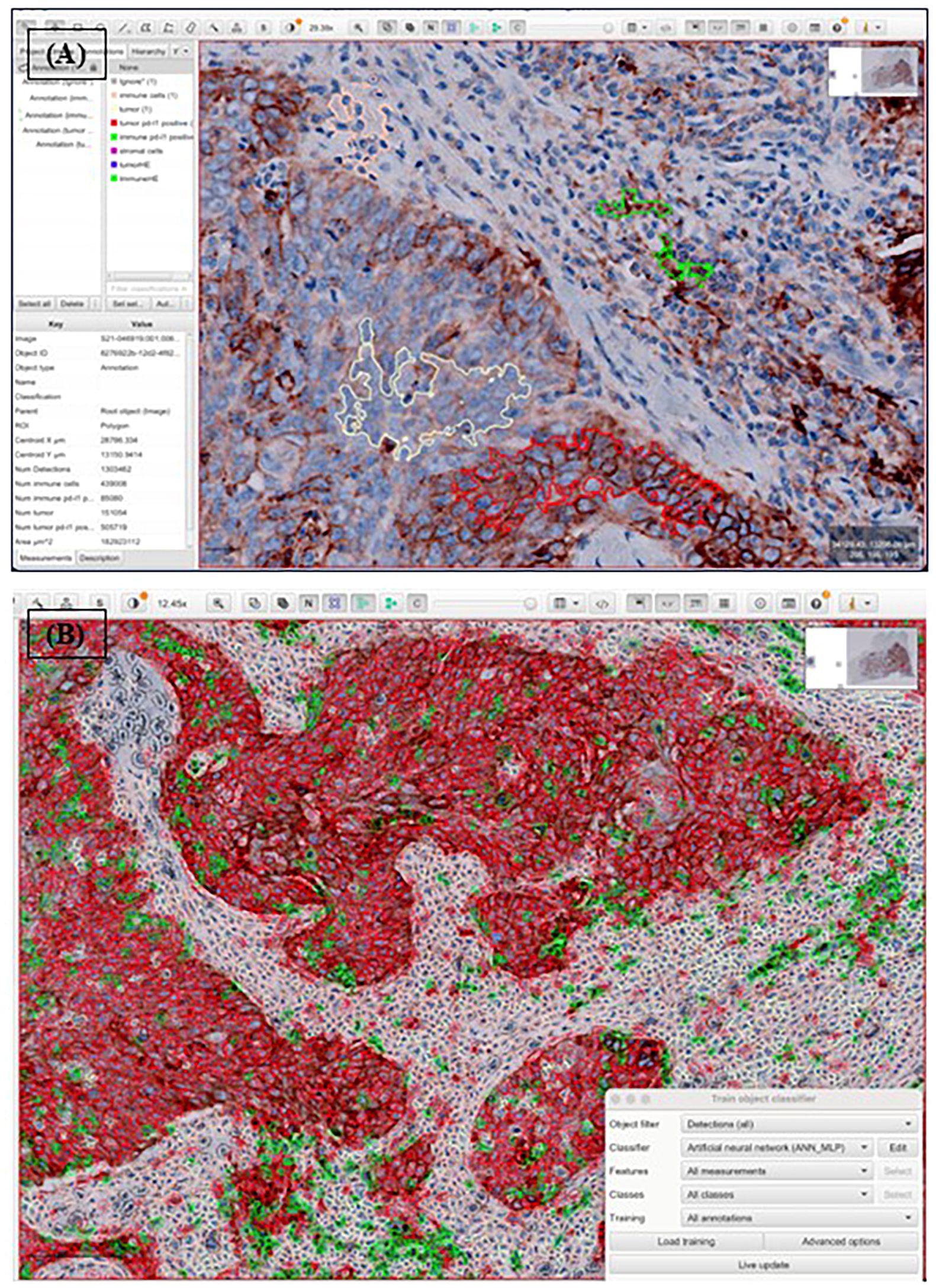 Histological images of tissue samples with annotated regions. Panel A shows detailed cellular structures with color-coded areas in light yellow, pink, red, and green, representing tumor cells, immune cells, PD-L1–positive tumor cells, and PD-L1–positive immune cells, respectively. Panel B illustrates the application of these annotations to whole PD-L1–stained slides, enabling comprehensive classification of cell populations. Both panels include software interface elements for image analysis and classification.