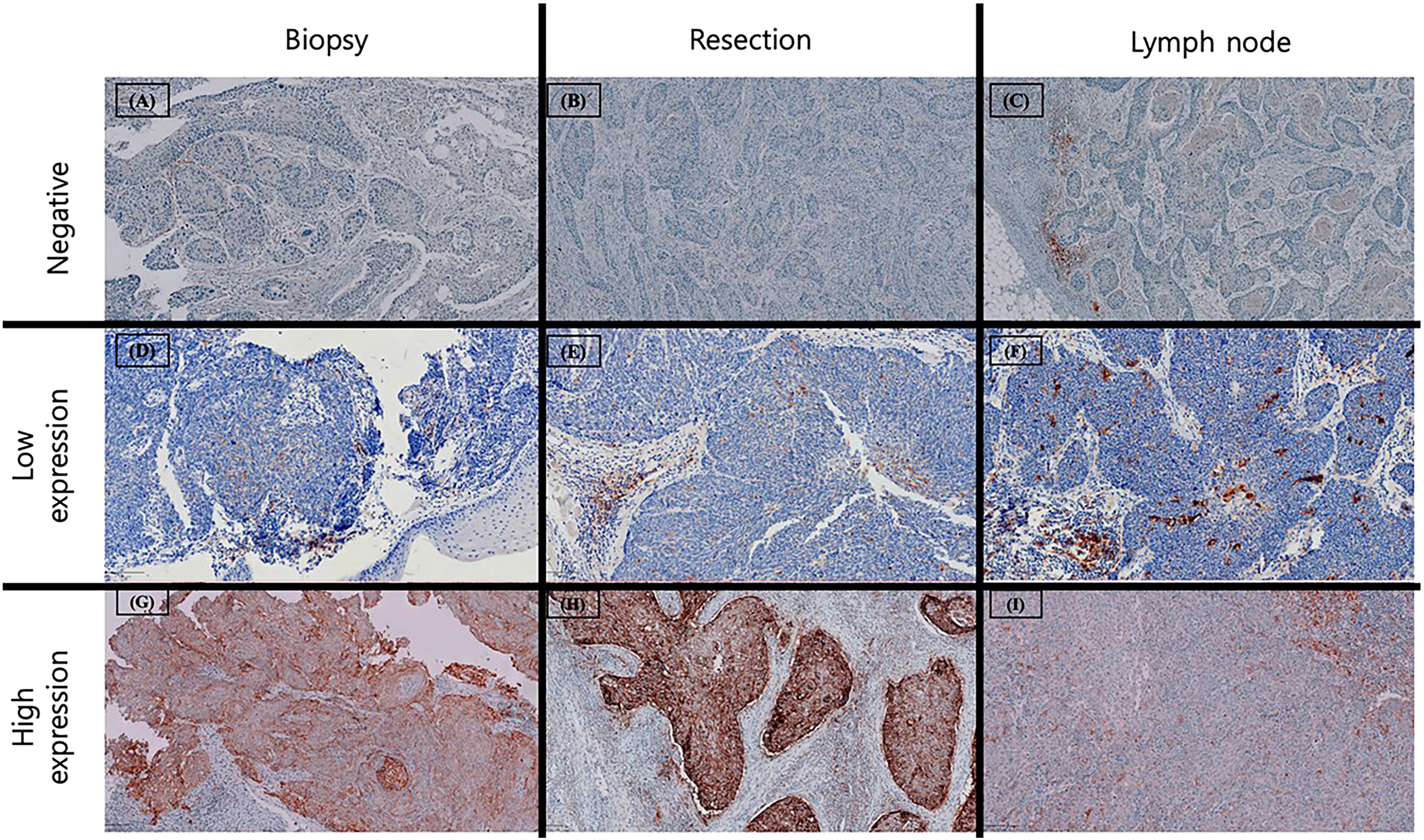 Histological image grid showing varying levels of expression. Top row (A-C) indicates negative expression in biopsy, resection, and lymph node samples. Middle row (D-F) shows low expression with increased staining in similar sample types. Bottom row (G-I) illustrates high expression with intense staining. Each section represents different tissue reactions.