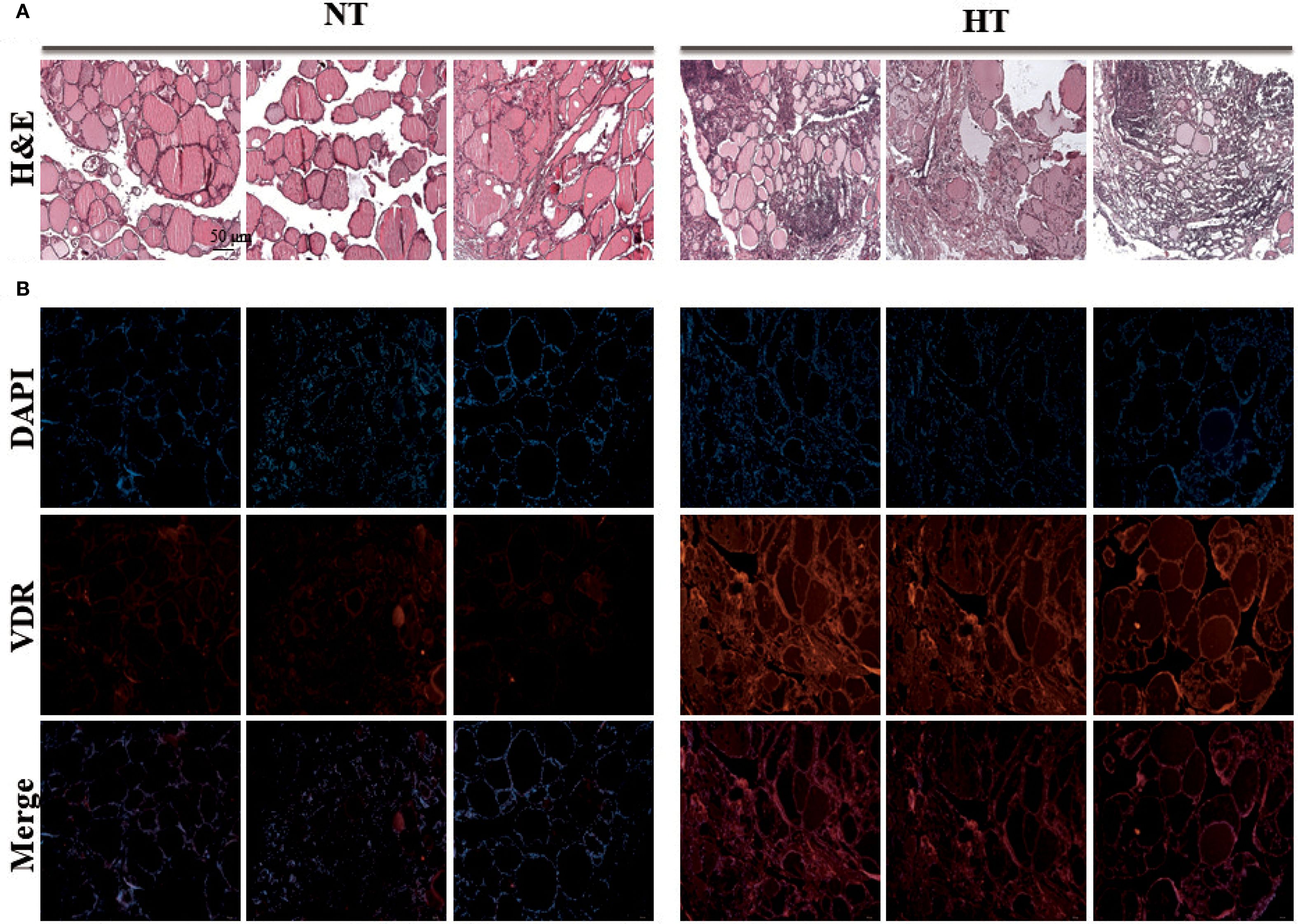 Panel A shows histological images with H&E staining, comparing NT (normal thyroid) and HT (hashimoto's thyroiditis) tissues. Panel B includes fluorescent images with DAPI staining for nuclei, VDR staining, and merged images for both NT and HT samples, highlighting differences in expression.