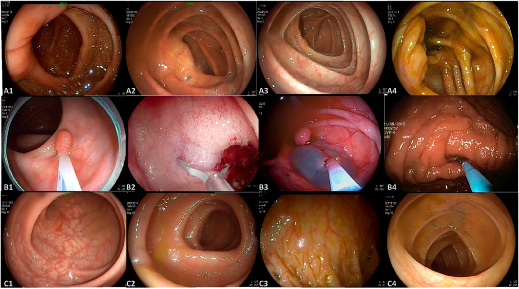 Twelve-panel endoscopic images showing various views of the colon interior. Panels A1 to A4 depict healthy sections of the colon with normal folds and mucosa. Panels B1 to B4 illustrate medical intervention, including polyp removal and biopsy procedures. Panels C1 to C4 show post-procedural views with normal and treated areas displaying slight color variations.