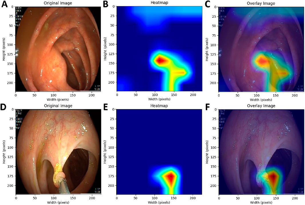 A series of medical images illustrating endoscopy views and corresponding heatmaps. Panels A and D show original endoscopic images of the gastrointestinal tract. Panels B and E display heatmaps with highlighted regions in red and yellow, indicating areas of interest. Panels C and F are overlay images combining the original views and heatmaps, showing highlighted areas on the endoscopic images. Each panel includes pixel dimensions on the axes.