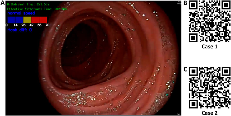 Endoscopic image of a colon with visible texture and color. Top left displays withdrawal time of 279.56 seconds and effective time of 202.40 seconds. Color-coded speed chart and hash difference of zero are also shown. Two QR codes labeled