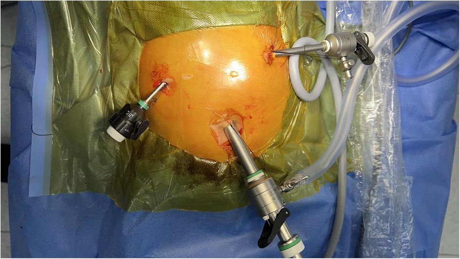 The figure illustrates the placement of three laparoscopic ports within the abdominal cavity: a single 10-mm camera port inserted through the umbilicus and two additional 5-mm working ports positioned in the right and left upper quadrants.