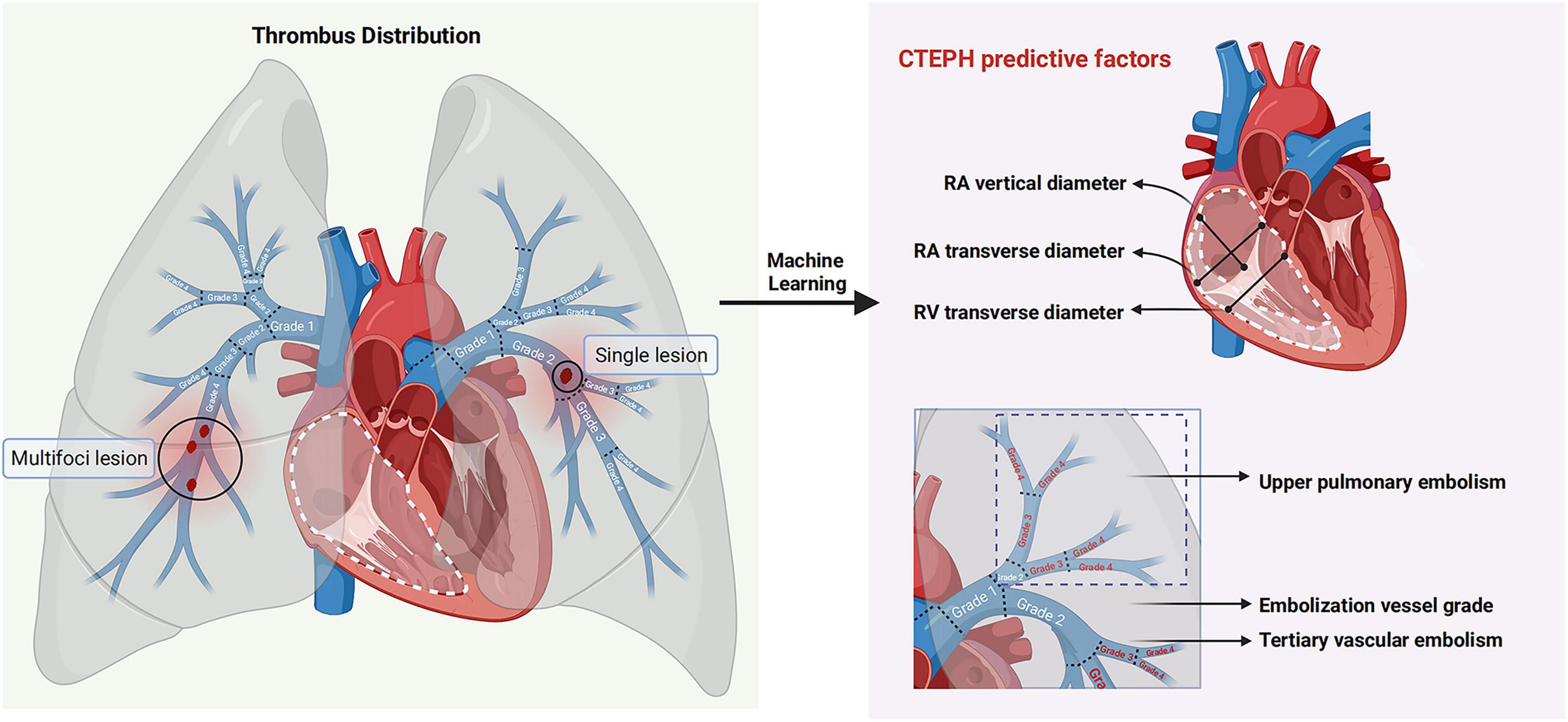 Diagram illustrating thrombus distribution and CTEPH predictive factors. Left panel shows a lung with multifocal and single lesions, marked as grades 1 and 2. Right panel details cardiac anatomy with RA and RV diameter labels. It highlights upper pulmonary embolism, embolization vessel grade, and tertiary vascular embolism, linked to machine learning.