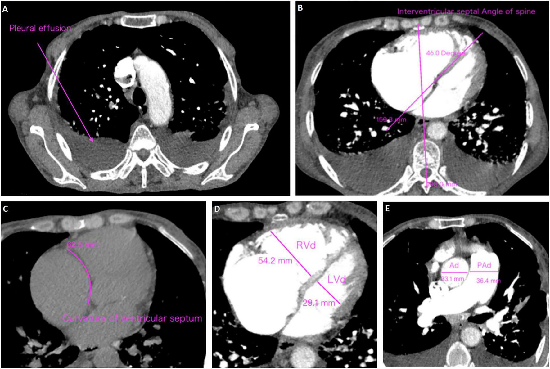 CT scan images showing various thoracic measurements. Panel A indicates pleural effusion. Panel B displays the interventricular septal angle relative to the spine, measuring forty-six degrees. Panel C illustrates the curvature of the ventricular septum at eighty-two point five millimeters. Panel D shows the right ventricular diameter (RVD) at fifty-four point two millimeters and the left ventricular diameter (LVD) at twenty-nine point one millimeters. Panel E compares aortic diameter (Ad) at thirty-eight point one millimeters to pulmonary artery diameter (PAd) at thirty-six point four millimeters.