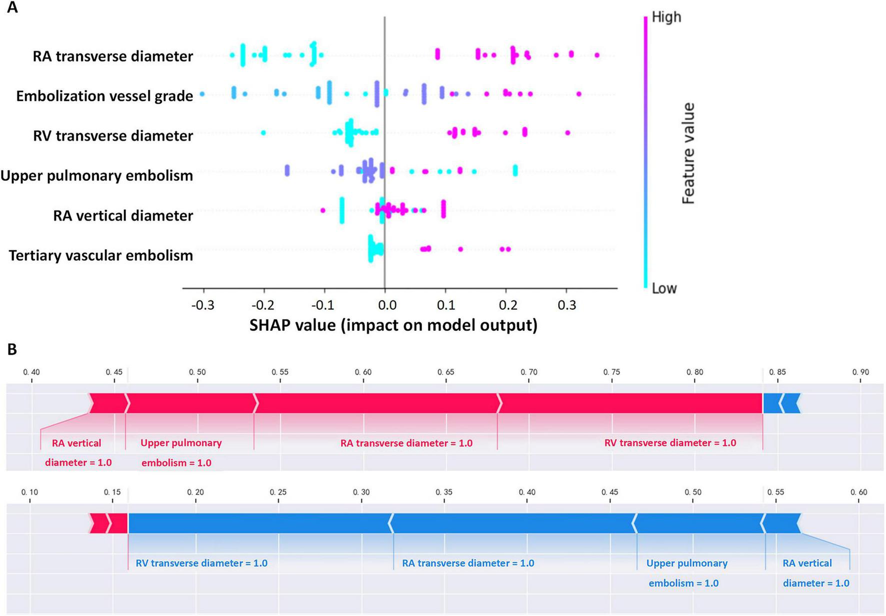 “Image contains two panels: Panel A: A SHAP value plot shows the impact of various features on the model output, including RA transverse diameter, embolization vessel grade, and RV transverse diameter, with feature values represented by colors from blue (low) to pink (high). Panel B: A decision plot illustrates the contributions of features such as RA vertical diameter and RV transverse diameter on the model’s prediction, with contributions marked in red and blue along the x-axis range from 0.1 to 0.9.”