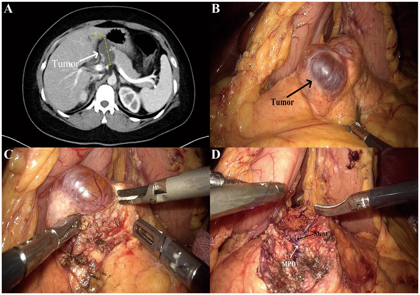 Panel A shows a CT scan with a labeled tumor and a measurement of forty-eight millimeters. Panel B is an intraoperative view identifying a visible tumor. Panel C displays surgical tools accessing the tumor. Panel D shows surgical instruments near a stent and a labeled Main Pancreatic Duct (MPD).