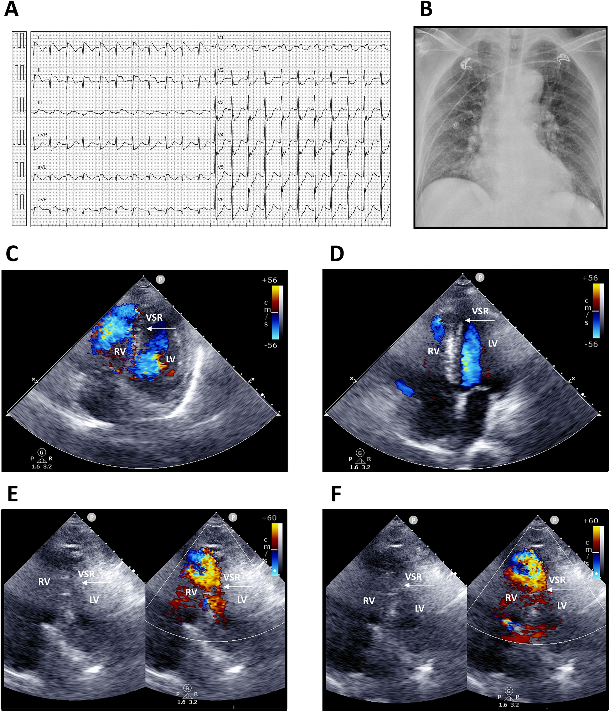 Medical images showing several diagnostic tests. Panel A: Electrocardiogram (ECG) with irregular readings. Panel B: Chest X-ray displaying the thoracic cavity. Panels C and D: Echocardiograms with color Doppler showing ventricular septal rupture (VSR) between right ventricle (RV) and left ventricle (LV). Panels E and F: Further echocardiograms highlighting blood flow velocity through the VSR, with colored Doppler analysis showing flow direction and speed.