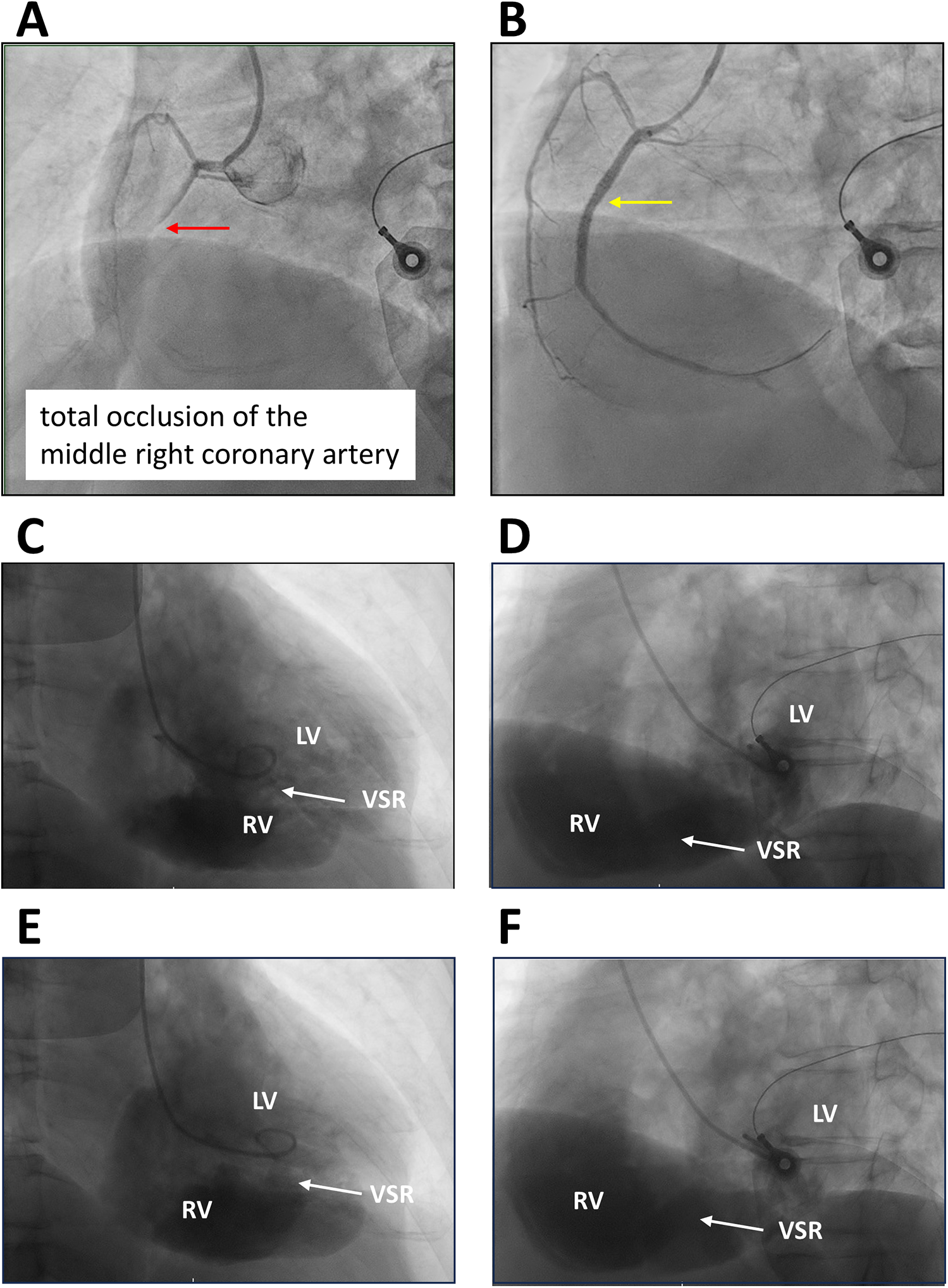 Panels A and B show angiographic images with arrows indicating coronary artery paths. Panel C to F shows heart ventricles with arrows marking a ventricular septal rupture (VSR) between the left (LV) and right ventricles (RV). Panel A highlights total occlusion in the middle right coronary artery.