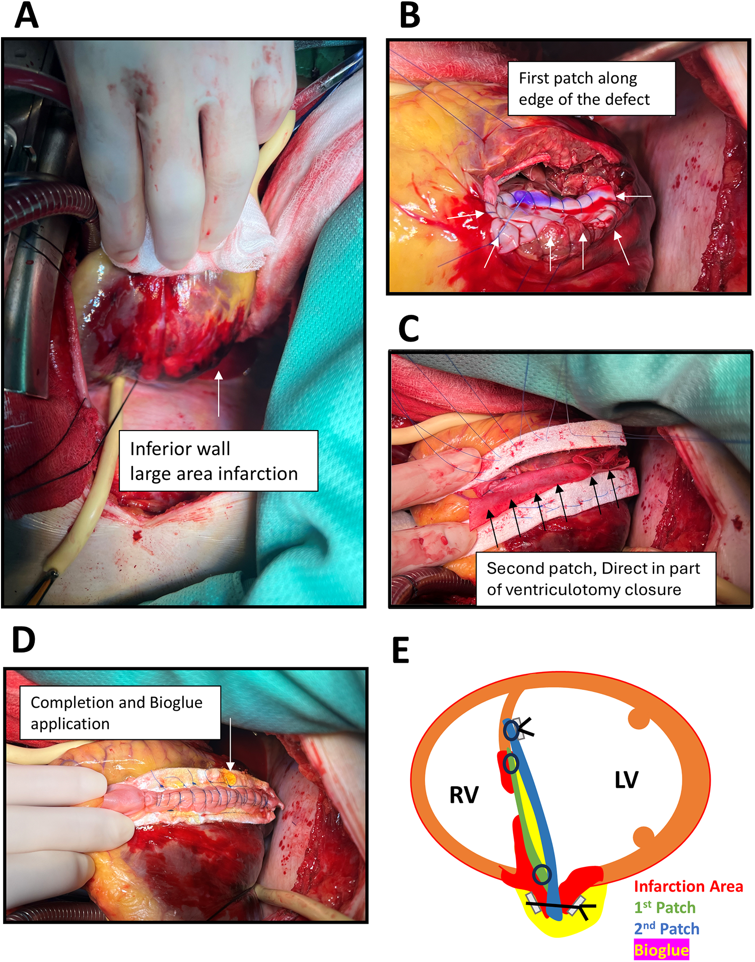Panel A shows an exposed heart with an inferior wall infarction area. Panel B depicts the first patch applied along the defect edge. Panel C displays a second patch used in part of the ventriculotomy closure. Panel D shows completion with Bioglue application. Panel E is a diagram illustrating the infarction area, first and second patches, and Bioglue on the right (RV) and left ventricles (LV).
