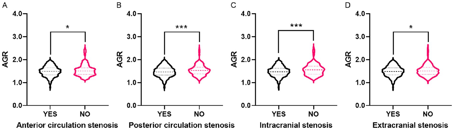 Four violin plots labeled A to D compare AGR values for different types of stenosis: anterior circulation, posterior circulation, intracranial, and extracranial. Each plot shows values for