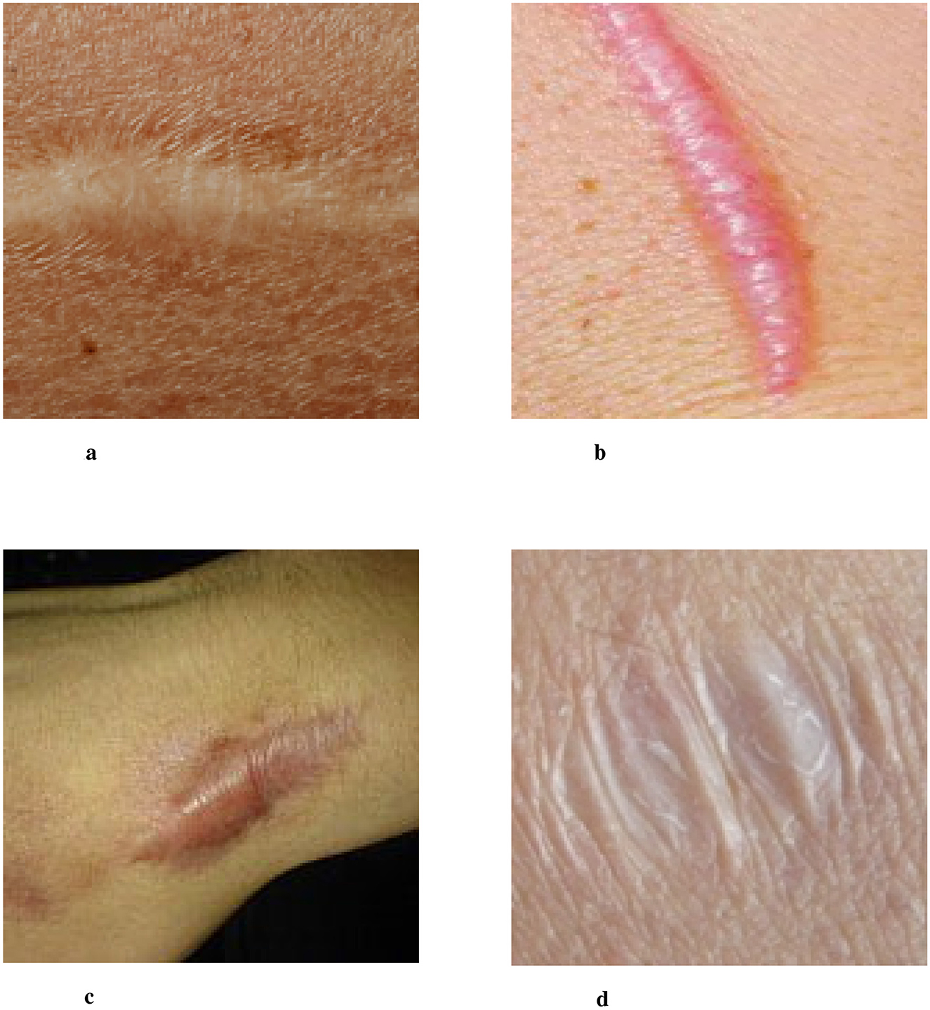 Four images of different scar types labeled a, b, c, and d. Image a shows a flat, pale scar. Image b depicts a raised, pinkish scar. Image c features a wide, darkened scar. Image d shows a wrinkled, white scar.