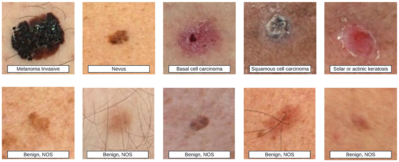Top row shows various skin lesions labeled as melanoma invasive, nevus, basal cell carcinoma, squamous cell carcinoma, and solar or actinic keratosis. Bottom row contains different benign skin lesions labeled as benign, NOS.