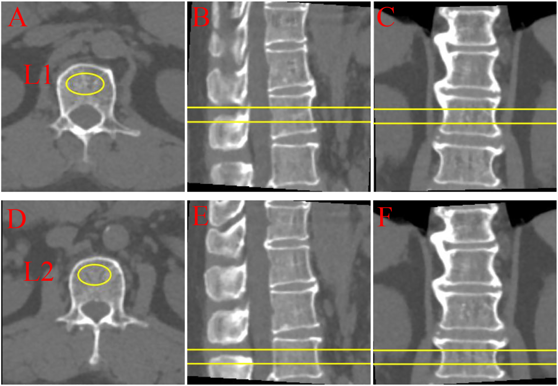 CT scan panel showing vertebrae images. Panels A and D display axial views of L1 and L2 vertebrae with yellow-encircled areas. Panels B, C, E, and F show sagittal views with horizontal yellow lines indicating levels of intersection.