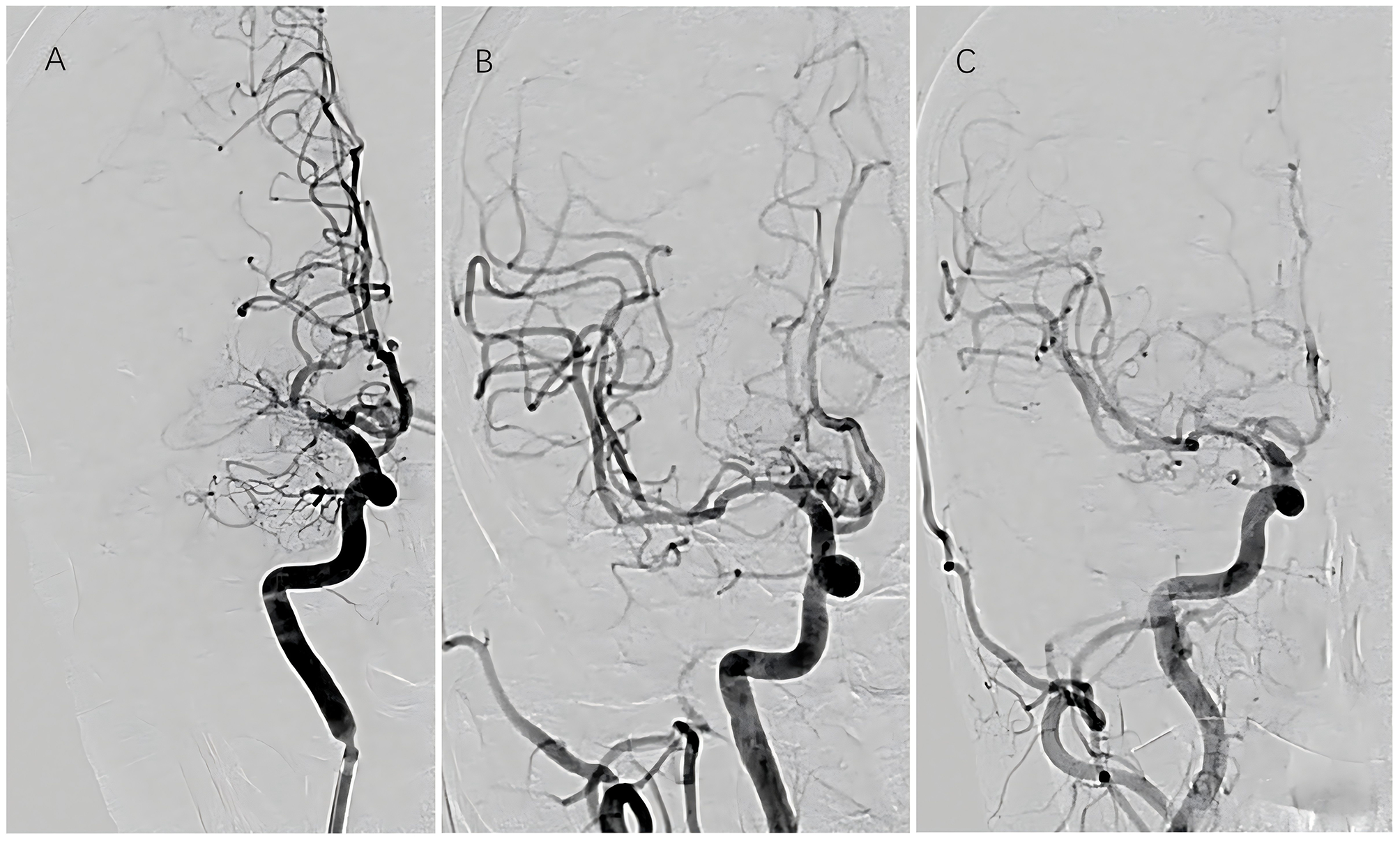A – Pre-operative: occlusion at the origin of the MCA. B – Immediate post-operative: the MCA is patent without significant stenosis. C – Six-month follow-up: the MCA contour remains widely patent without recurrent stenosis.