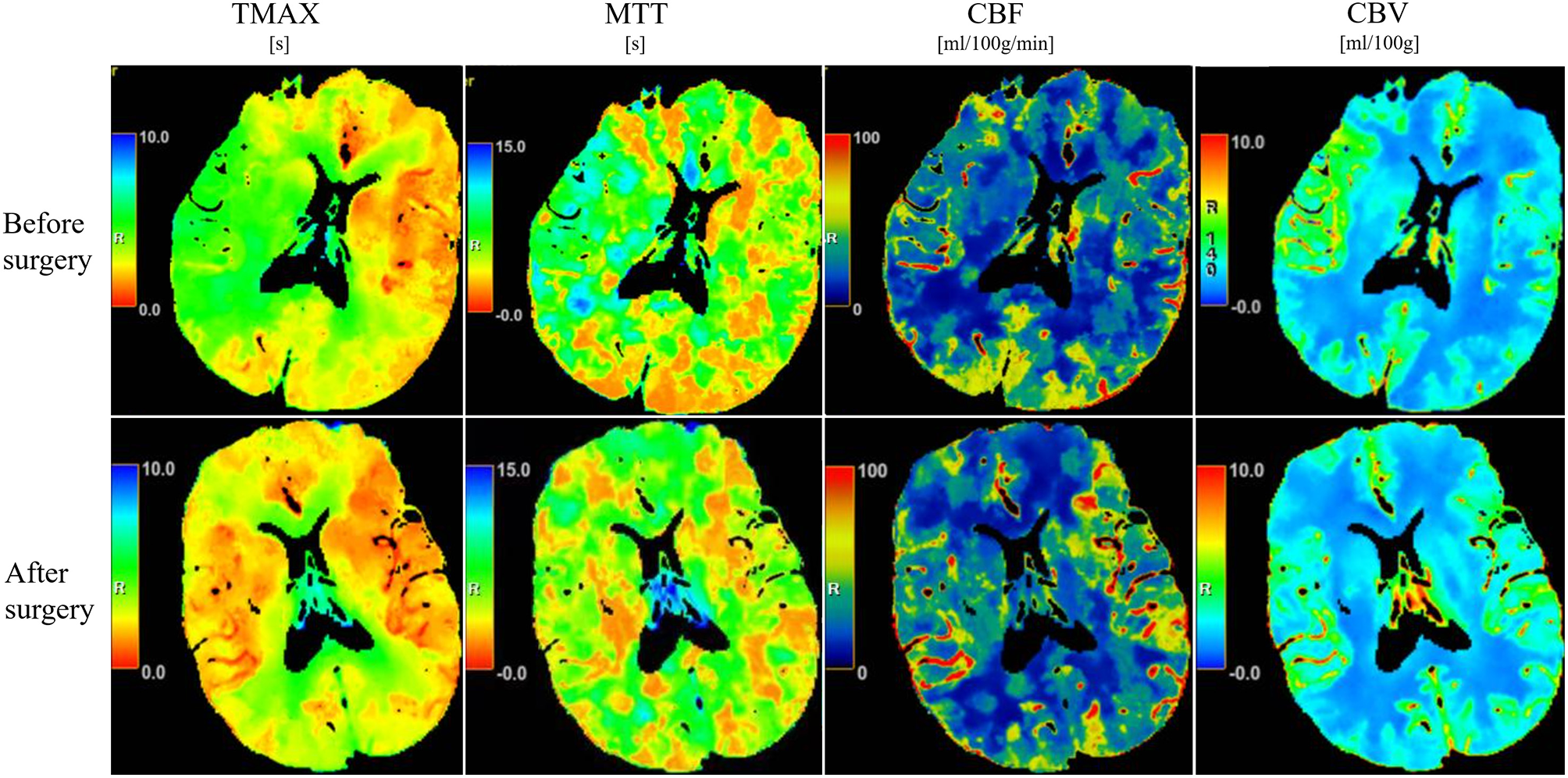 Pre-operative: TMAX and MTT maps demonstrate a large ischemic territory in the right MCA distribution. Six months post-operative: TMAX and MTT show near-complete resolution of the previously noted ischemic area.