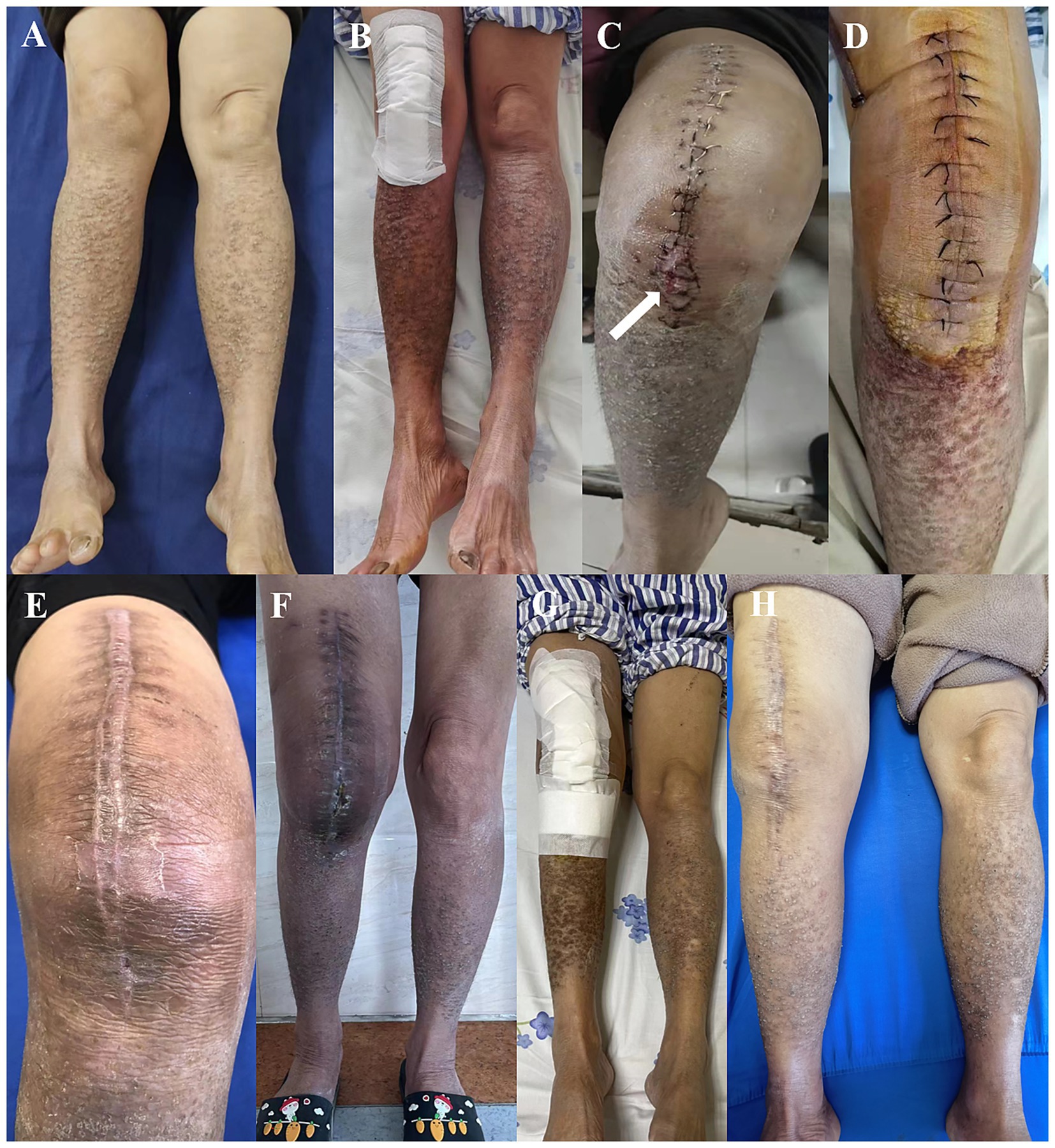 Eight-panel image showing various stages of leg surgeries and healing:A: Legs with dry skin.B: One bandaged leg, showing darkened skin.C: Freshly stitched knee post-surgery.D: Healing knee with stitches and slight discoloration.E: Healed knee with scar.F: Legs with visible scar.G: Partially bandaged leg.H: Healed leg with scar, resting on blue fabric.
