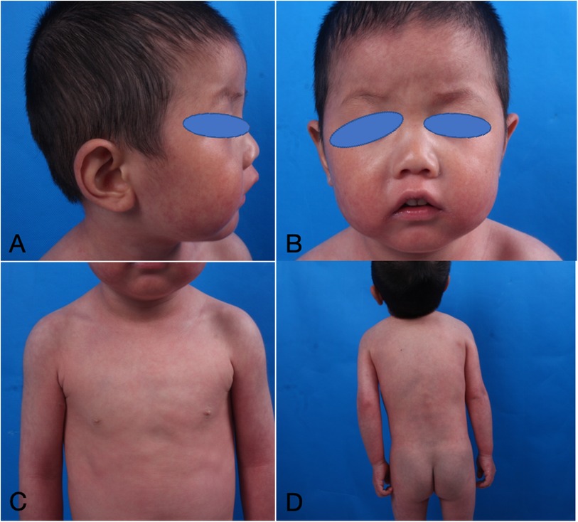 Four images of a young child with apparent skin discoloration and flushing. A: Side view of the face showing redness. B: Front view of the face with flushed cheeks. C: Front view of the torso with light skin discoloration. D: Back view showing similar discoloration across the child's body.