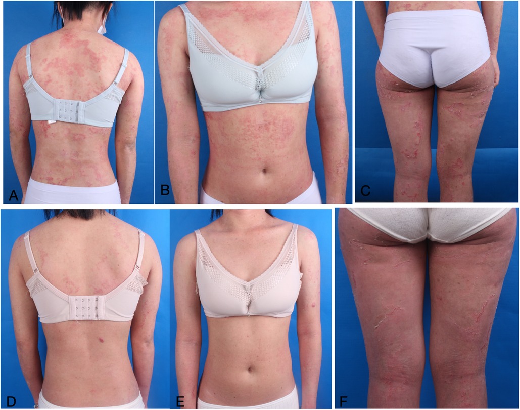 A series of images showing a person with extensive skin redness and patches, primarily on the back, arms, and legs. Images A, B, C, D, E, and F highlight different body areas with similar symptoms on a blue background.