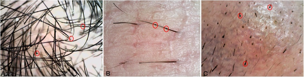 Three microscopic images display different types of hair shafts. Image A shows dense, dark hair with red circles highlighting specific areas. Image B presents lighter skin with fewer, darker hairs, also marked by red circles. Image C illustrates sparse hair growth on pinkish skin with red circles indicating particular spots.