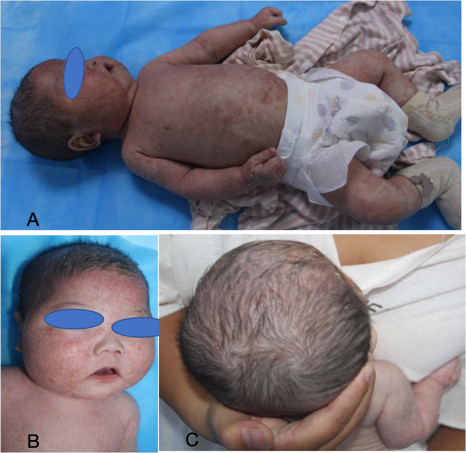 A three-panel image showing a baby with skin conditions. Panel A: Baby lying on a blue surface with visible redness and scaling on the skin. Panel B: Close-up of the baby's face with red and scaly skin. Panel C: Top view of the baby's head showing patchy hair loss and flaky skin.