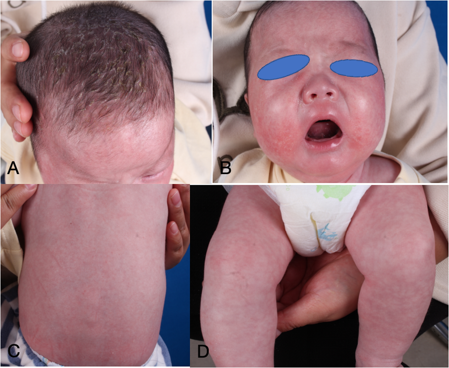 Four-panel image showing a baby with various skin conditions. Panel A shows scaly patches on the scalp. Panel B displays facial redness and irritation, eyes covered for privacy. Panel C reveals redness on the back. Panel D highlights redness and irritation on the legs.