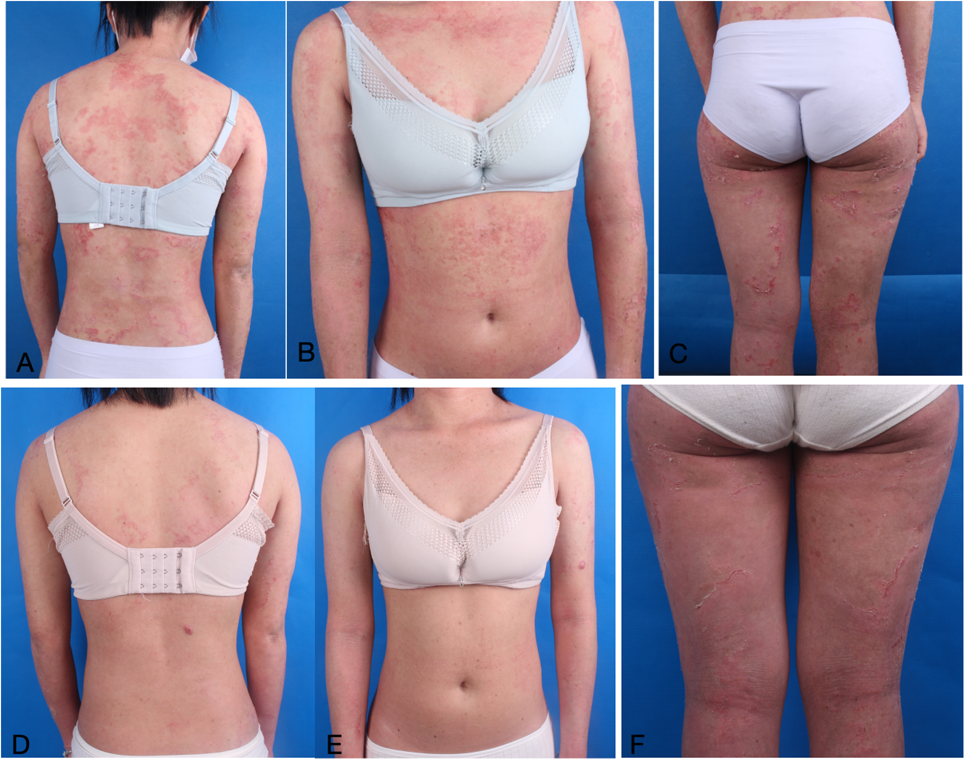 A series of images showing a person with extensive skin redness and patches, primarily on the back, arms, and legs. Images A, B, C, D, E, and F highlight different body areas with similar symptoms on a blue background.