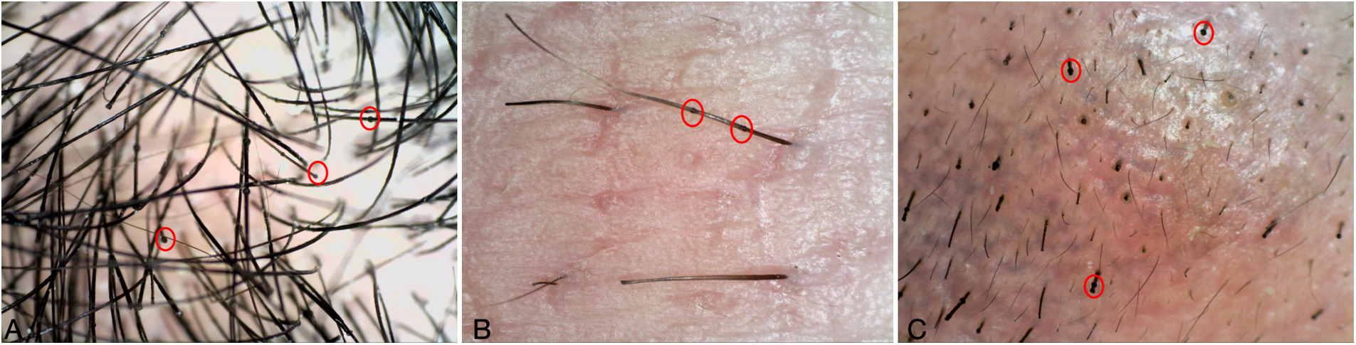 Three microscopic images display different types of hair shafts. Image A shows dense, dark hair with red circles highlighting specific areas. Image B presents lighter skin with fewer, darker hairs, also marked by red circles. Image C illustrates sparse hair growth on pinkish skin with red circles indicating particular spots.