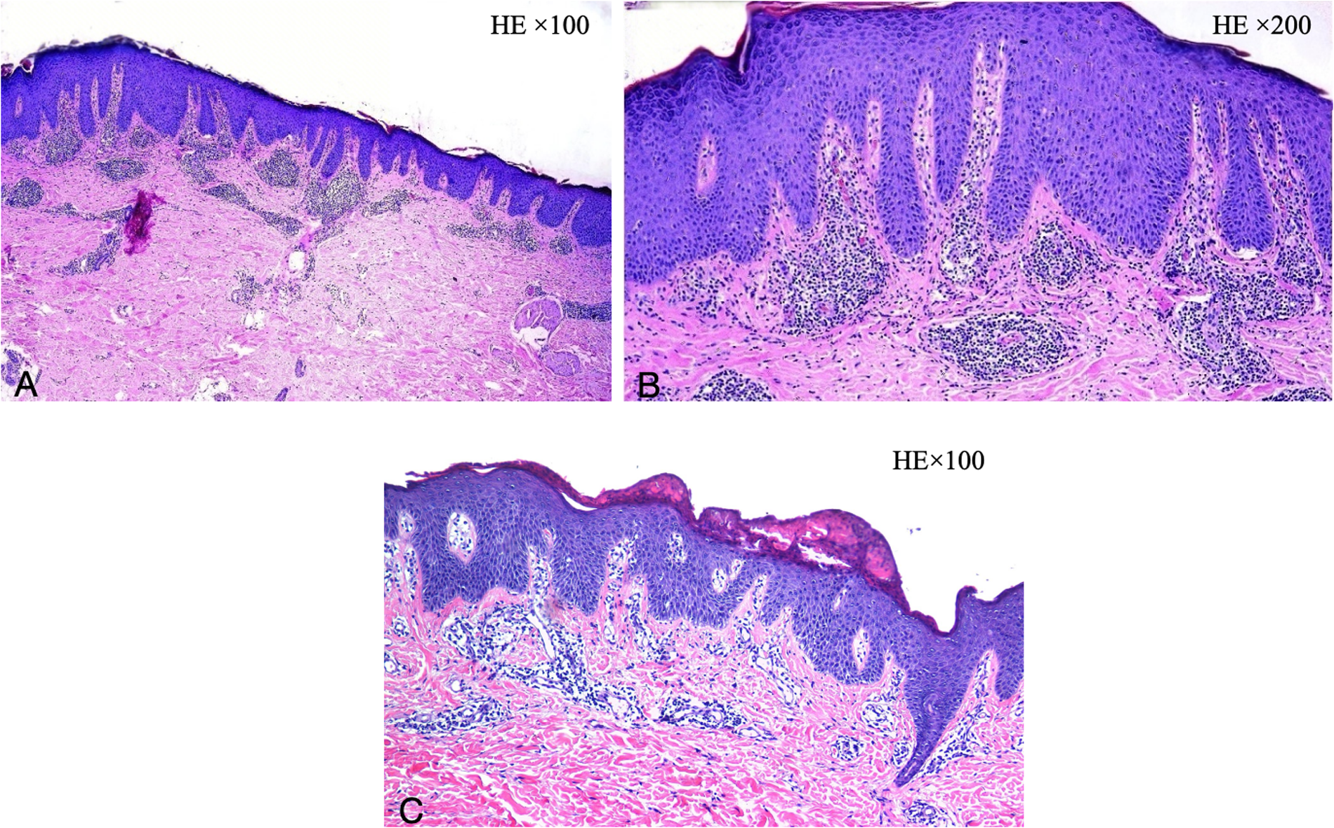 Histological images of skin tissue stained with hematoxylin and eosin, showing different magnifications. Image A (100x) and C (100x) display broader tissue structures, while Image B (200x) provides a closer view of epidermal layers and dermal papillae. The tissue sections highlight cell layers and connective tissues in varying shades of purple and pink.