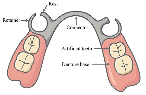 Illustration of a removable partial denture showing components labeled as retainer, rest, connector, artificial teeth, and denture base. The retainer and rest are metal, while the artificial teeth and denture base are pink.