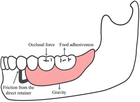 Illustration of lower jaw teeth and denture showing forces acting on it. Arrows indicate occlusal force, food adhesiveness, friction from the direct retainer, and gravity, demonstrating how these forces interact with the denture and teeth.