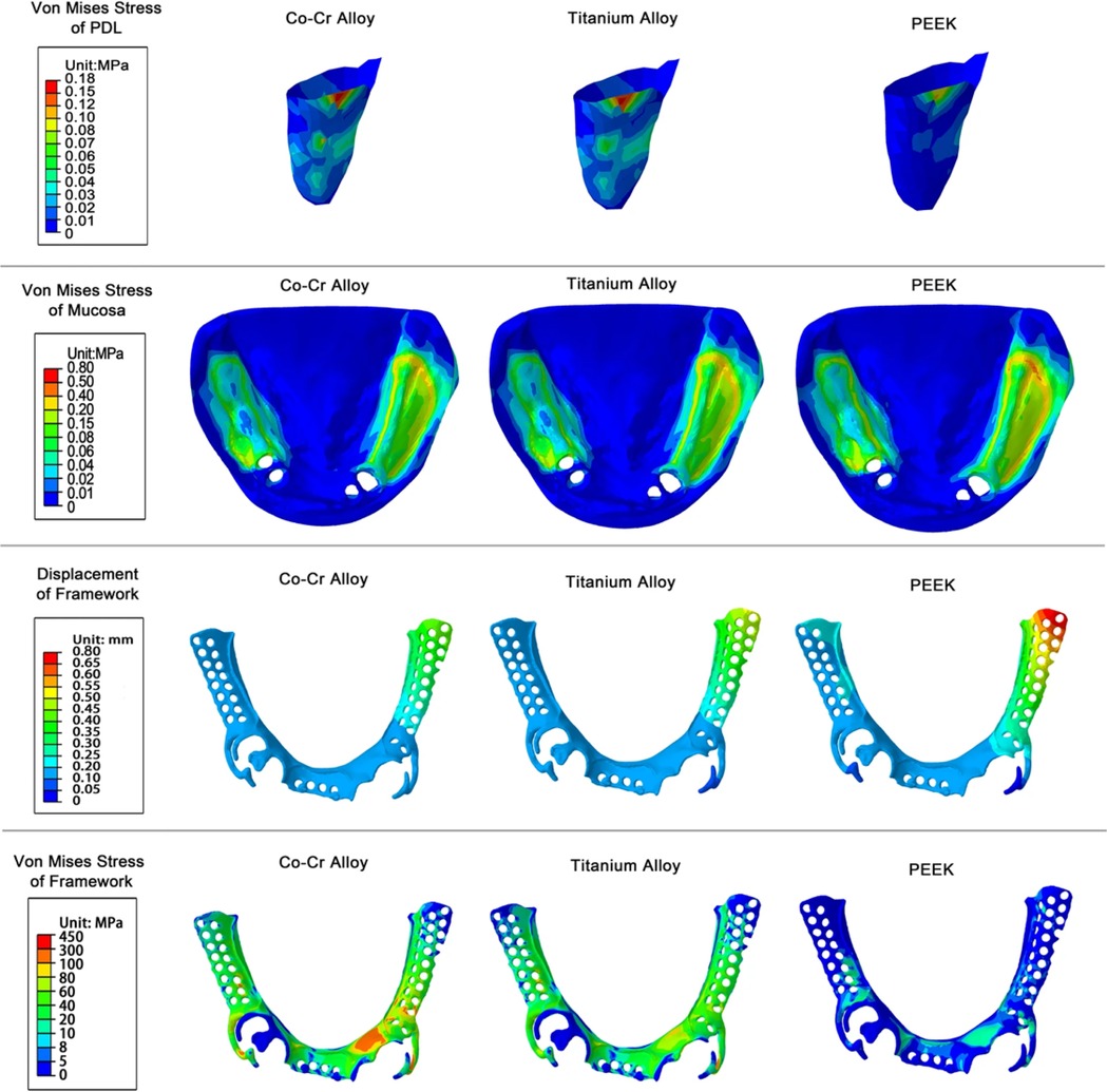 Comparative analysis of Von Mises stress and displacement for different materials. Top row: stress distribution on periodontal ligament (PDL) in Co-Cr alloy, titanium alloy, and PEEK; stress levels shown with a color scale of 0.01 to 0.18 MPa. Second row: stress on mucosa with color scale from 0 to 0.80 MPa. Third row: displacement of framework in millimeters with a color scale from 0 to 0.80 mm. Bottom row: stress on frameworks with a scale from 0 to 450 MPa. Each row compares Co-Cr alloy, titanium alloy, and PEEK.