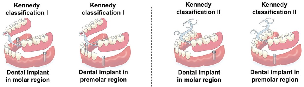 Four illustrations show different dental implant placements according to Kennedy classifications. The first two illustrations depict Kennedy classification I with dental implants in the molar and premolar regions, and the last two show Kennedy classification II with dental implants in the molar and premolar regions.