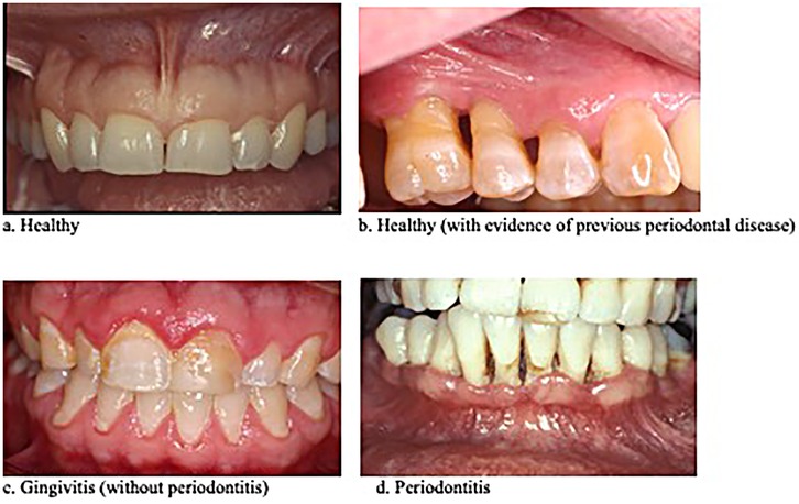 Panel (a) shows healthy teeth and gums. Panel (b) depicts healthy teeth with signs of previous periodontal disease. Panel (c) illustrates gingivitis with inflamed gums and no periodontitis. Panel (d) demonstrates periodontitis with gum recession and dental plaque.