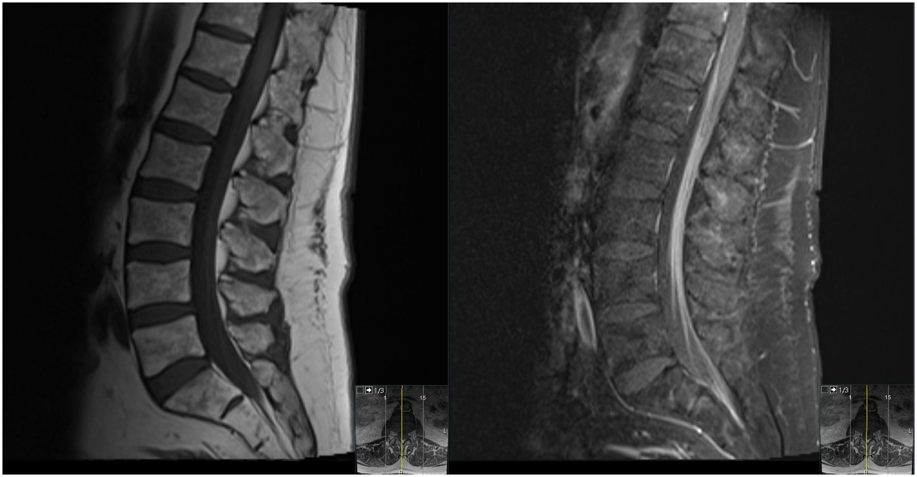 MRI scans of the lumbar spine are shown side by side. The left image is a pre-contrast image that depicts the cauda equina structures, while the right image shows post-contrast enhancement of the same structures. Together, these images point toward acute pathology involving the cauda equina with normal appearing surrounding structures.