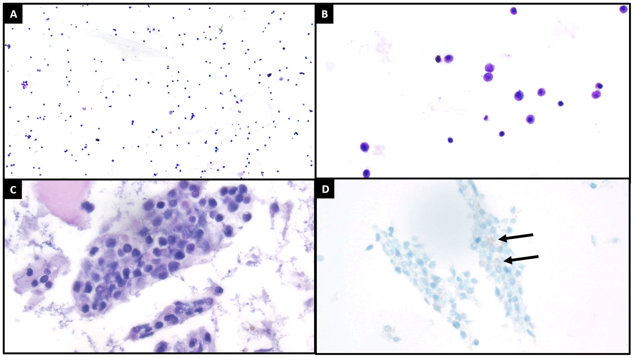 Four microscopic images showing cell populations from cerebrospinal fluid stained for analysis. Panel A and B show small blue and purple leukocytes at 100 and 400 times magnitude, respectively. Panel C shows a cluster of dark-stained cells. Panel D shows a cluster of light-stained cells with two arrows indicating areas of CD117-positive cells.
